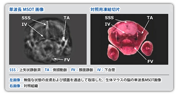 Tumor hypoxia