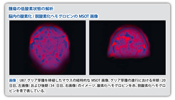 グリア芽腫