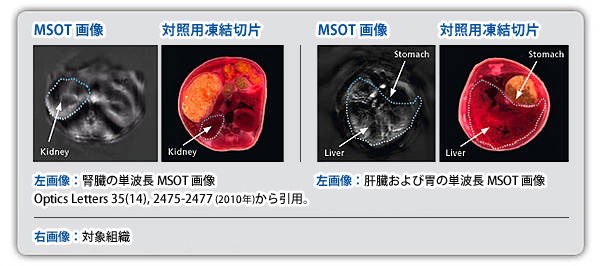 Tumor hypoxia