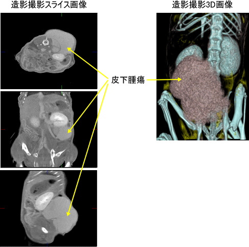 腫瘍の3D撮影