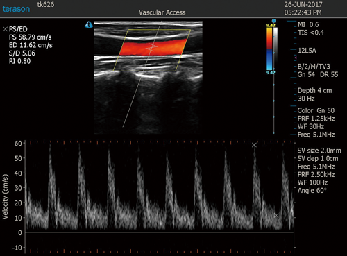 血流速度・血流量測定が可能 